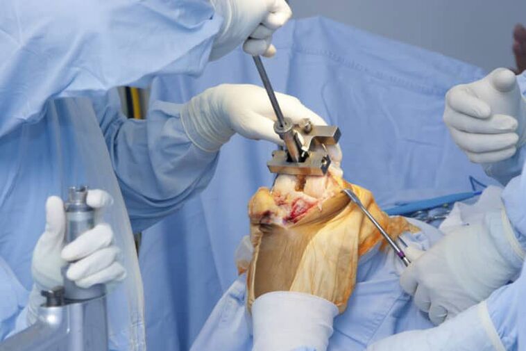 χειρουργική επέμβαση αρθρώσεων γόνατος