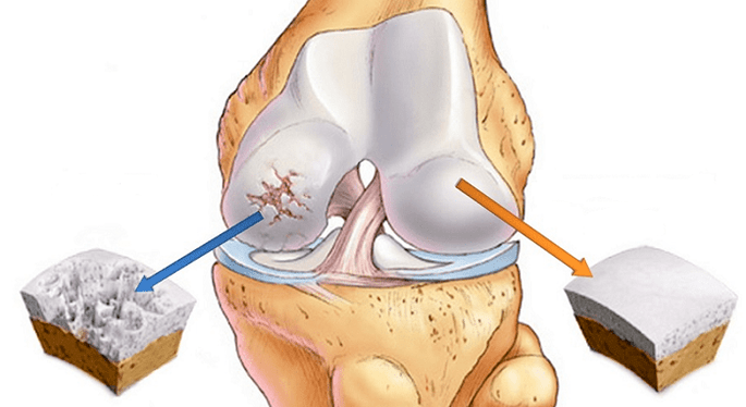 υγιείς χόνδροι και χόνδροι που επηρεάζονται από την αρθροπάθεια
